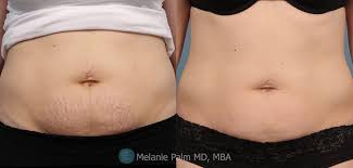 Stretch marks aren't painful or harmful, but some people don't like the way they make their skin look. San Diego Stretch Marks Treatment Stretch Mark Removal
