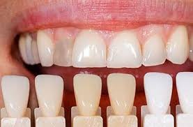 Internes Bleaching Fur Wider Weisse Zahne Mit Bleaching