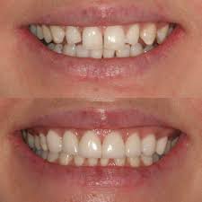 Check spelling or type a new query. What You Need To Know About Dental Veneers Forever Dental And Skin