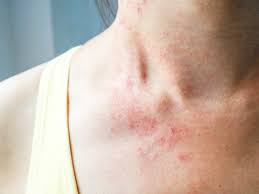 Image result for skin rash similar to scabies