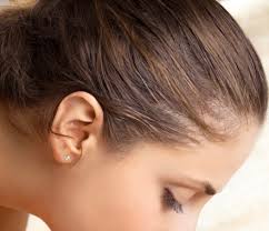 L'alopécie localisée (alopecia areata) est une forme moins fréquente de perte de cheveux qui consiste en une pelade en plaques chauves, les cheveux tombant d'une façon. Perte De Cheveux Causes Et Origines Centre Clauderer