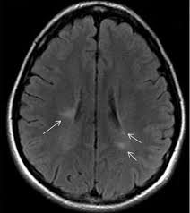 There is no cure for ms, but treatments are available to slow the progression of the disease and manage symptoms. Multiple Sclerosis Chapter 22 Neurology