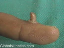 Image result for cornu cutaneum)