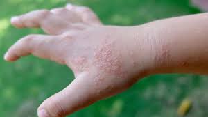 Image result for dyshidrosis
