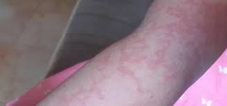 Check spelling or type a new query. Covid 19 En Forma De Ronchas Y Sabanones Familia Y Salud