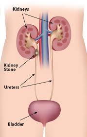 Imaging Tests To Check For Kidney Stones In The Emergency Department Effective Health Care Program
