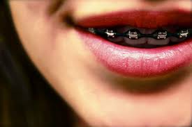 Can you be too old to get braces? The Stages Of Braces