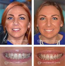 Six Month Smiles Plymouth Fast Invisible Braces Straightening Teeth Straightening Amazing Transformations Dental Braces