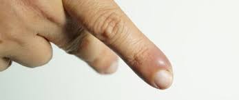 علاج الاصبع المدوحس ومعلومات هامة ويب طب Thumbs Up