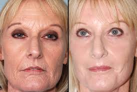 Medical specialties medical specialties proven clinical outcomes. Laser Wrinkle Treatment Laser Skin Resurfacing Laser Peels Fraxel Fractional Skin Resurfacing Salt Lake City Utah
