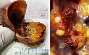 It is also a predominant type of cancer among children and patients who received chemotherapy treatment for cancers localized in the head and neck area. File Thyroglossal Cyst With Papillary Thyroid Cancer Annotated Jpg Wikipedia