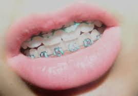 Braces Lips Cute Braces Braces Teeth Colors Braces Colors