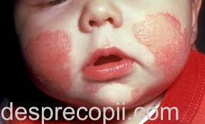Mai intai pe maini si in timp ele au continuat sa apara si pe picioare, genunchi sub brat. Eczema La Copil Legatura Cu Alergiile Si Cum Se Trateaza Sfatul Medicului Dermatolog Desprecopii Com