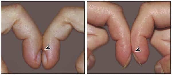 5 Cách kiểm tra ung thư phổi kết quả CHÍNH XÁC nhất : IIMS-VNM