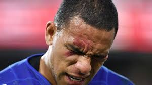 Hopoate to miss month with fractured eye