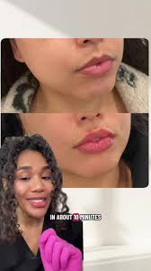 Jalisa Vaughn Lips Before and After