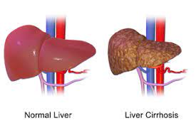 Cirrhosis Wikipedia