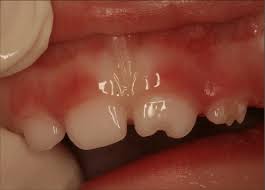 Enamel Hypoplasia Of The Left Maxillary Incisors In A Child Intubated Download Scientific Diagram