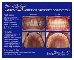 Pin On Braces Blog