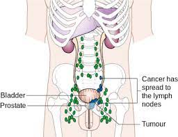 Prostate cancer spreads when cancer cells break free from the prostate. Expanding The Treatment Options For Prostate Cancer Part 2 Fire Engineering