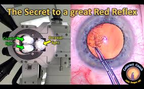 Image result for Red Reflex