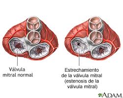 ¿qué es un estenosis aórtica? Estenosis Mitral Medlineplus Enciclopedia Medica