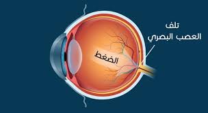 الماء الأزرق الجلوكوما مركز رؤية لطب وجراحة العيون
