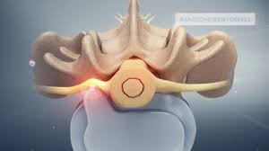 Therapeutische Infiltration An Der Wirbelsaule Schulthess Klinik