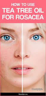 Tea Tree Oil For Rosacea Benefits And Uses Tea Tree Oil Face Moisturizer Tea Tree Oil Face Tea Tree Oil Uses