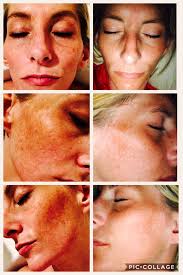 Me 18 weeks PO LTKR 8 weeks PO RTKR Don't forget as the weather gets nicer  ( not here in ND, we have 39” of snow and a blizzard coming this afternoon