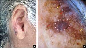Skin cancer is by far the most common type of cancer. Ear Melanoma A Four Case Series Sciencedirect