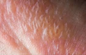 Treatments For Poison Ivy From A Dermatologist In Rancho Santa Margarita Ca Skin Care Specialist Brown Age Spots Poison Ivy Rash