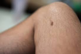 Image result for liver spots on legs