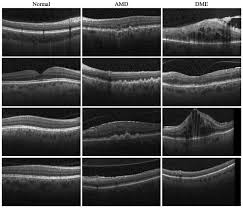 Open platform for makers and integrators. Fully Automated Detection Of Diabetic Macular Edema And Dry Age Related Macular Degeneration From Optical Coherence Tomography Images Abstract Europe Pmc