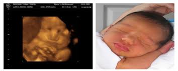 Video recording of your session on babyflix. Before And After 3d Ultrasound Images