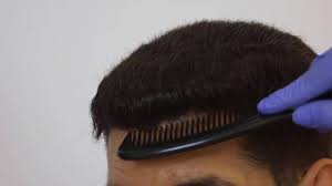 The quality of grafts in fue is better and more consistent compared to manual fue. Best Hair Transplant Clinics In Goa 2020