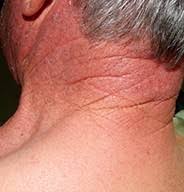 Image result for Photodermatitis