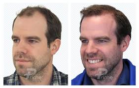 Despite gale's advice, hair transplants aren't for everyone and there's a lot to consider before going through with one. Calgary S Most Trusted Hair Clinic Hair Transplants Prime Hair Clinic