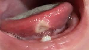 Image result for Neonatal Teeth