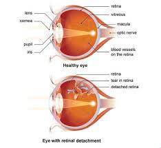 Image result for Retinal Detachment