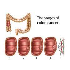 Or when a full independent clause precedes the colon. Stages Of Colon Cancer Colon Cancer Treatment In India Cytecare