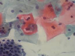 Ce n'est pas vraiment un état pathologique, mais le signe de « vie » du col. Qu Est Ce Qu Un Frottis