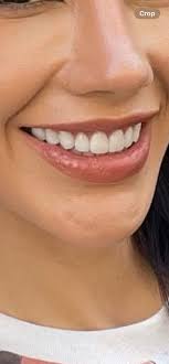 Instant teeth whitening and straightening options without braces