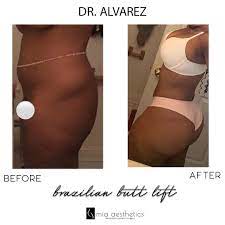 At mia aesthetics we provide the highest quality plastic surgery, all at affordable prices. Mia Aesthetics On Twitter Bbl By Dr Alvarez Https T Co B5iwtfs0je Twitter