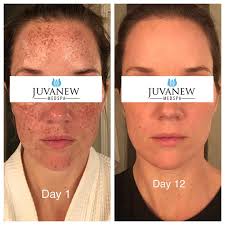 Juvanew Medspa