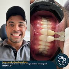 Já pensou em ter um resultado de clareamento desses, no conforto da sua  casa? Seus dentes ficando branquinhos enquanto tira um cochilo ou assiste  uma série. Faça como o Rafa, e deixe