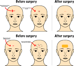 Skin keratosis, also known as seborrheic keratosis, are harmless, noncancerous growths that appear on the face, neck, shoulders. Facial Skin Cancer