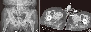 Joint trust clinical procedure for the management of foreign body in urethra / bladder v1.1; Subcutaneous Gas Of The Perineal Area Radiographic Signs Of Fournier S Gangrene