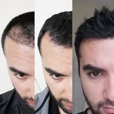 The shock loss usually continues for 2 months. Mini And Micro Grafts In Hair Transplant Surgery Site Title