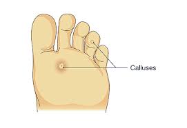 Stages 1 and 2 mean that the spot is thicker and has possibly broken the skin. Skin And Toenail Conditions Desert Podiatric